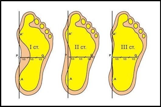 Плоскостопие - проблемма ног. Ортопедическая обувь
